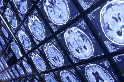 louisville injury lawyer brain scan